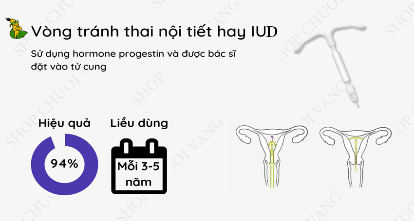 Đặt vòng tránh thai IUD